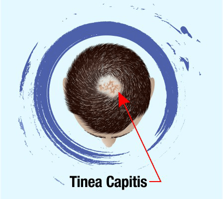 Tinea Capitis - Symptoms, Causes, Treatment & Prevention | RichFeel
