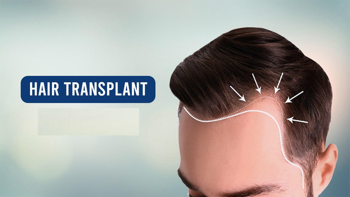 Which Is The Best Method For Hair Transplant In India Hair