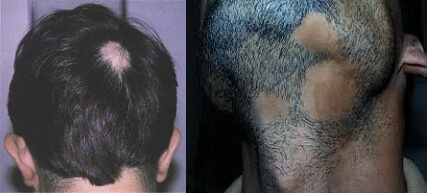 non_scarring_alopecia