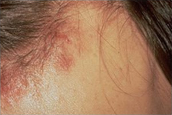 Dermatitis - Treatment, Causes, Symptoms, Risk Factors 