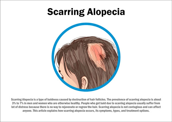 Scarring Alopecia Symptoms Causes Treatment Prevention