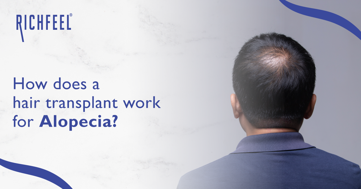 How Does A Hair Transplant Work For Alopecia? - RichFeel